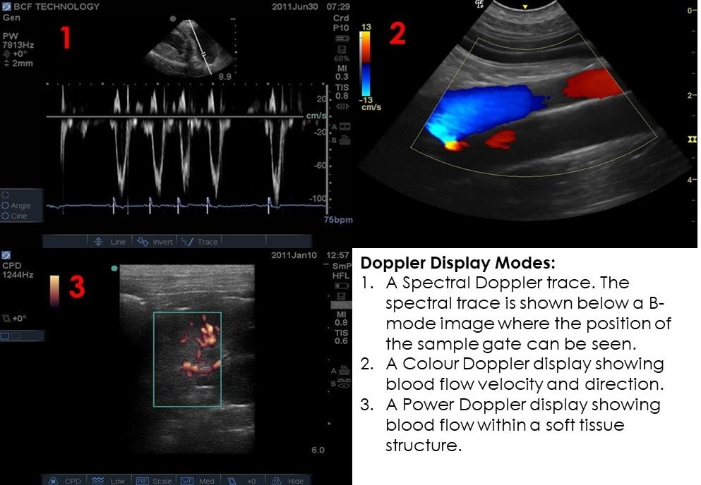 Doppler ultrasound explained