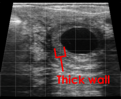 thick wall