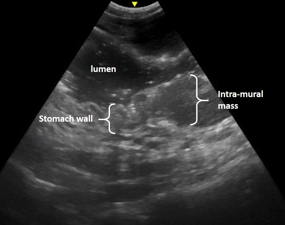 gastric lymphoma