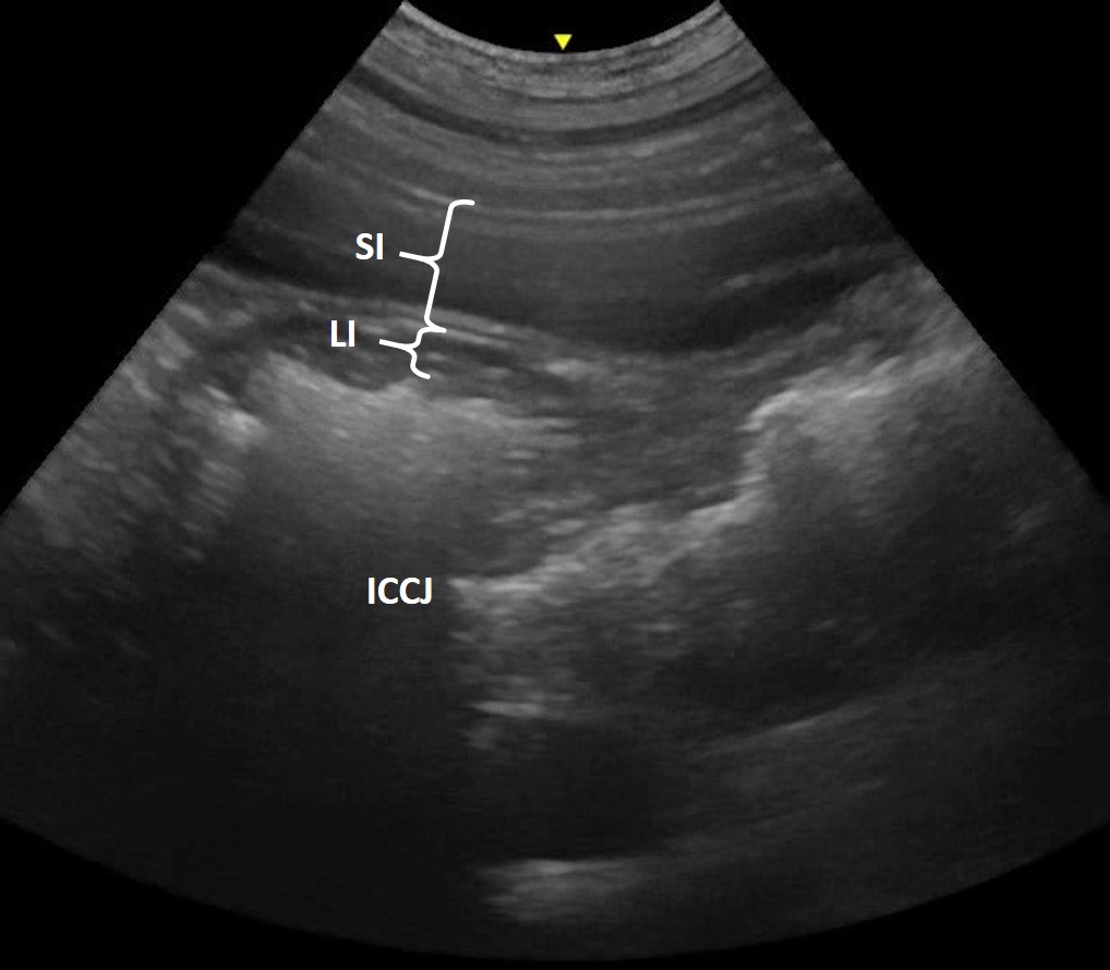 Ultrasonography of the gastrointestinal tract - Large intestinal wall thickness
