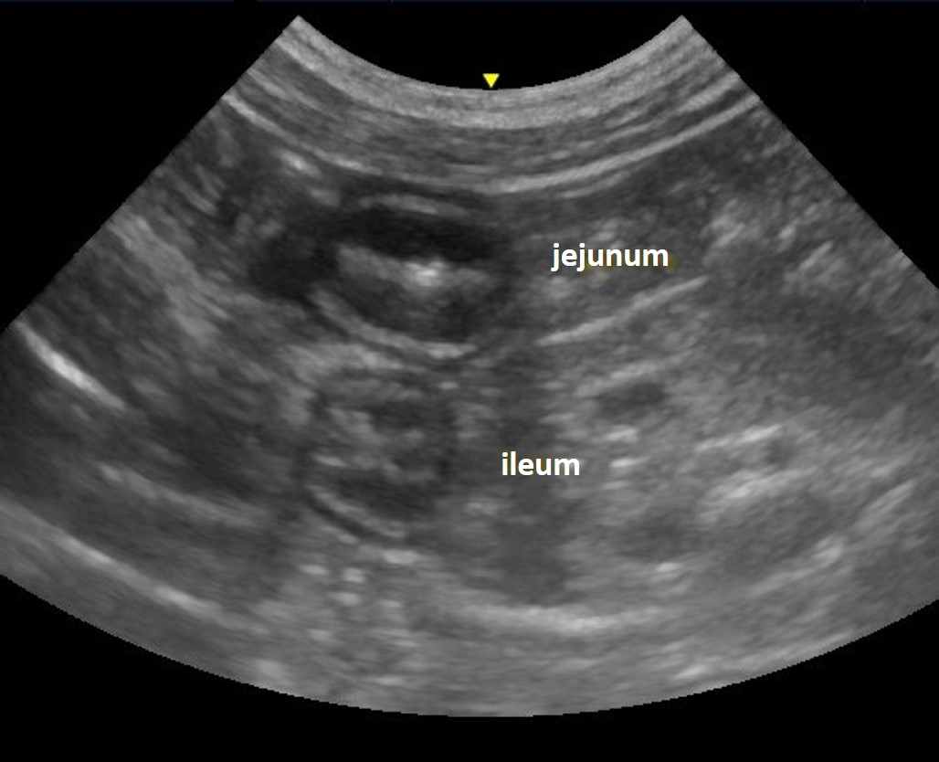 ileum