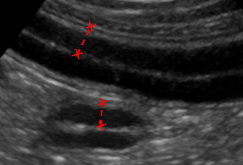 Ultrasonography of the gastrointestinal tract - GI measurements