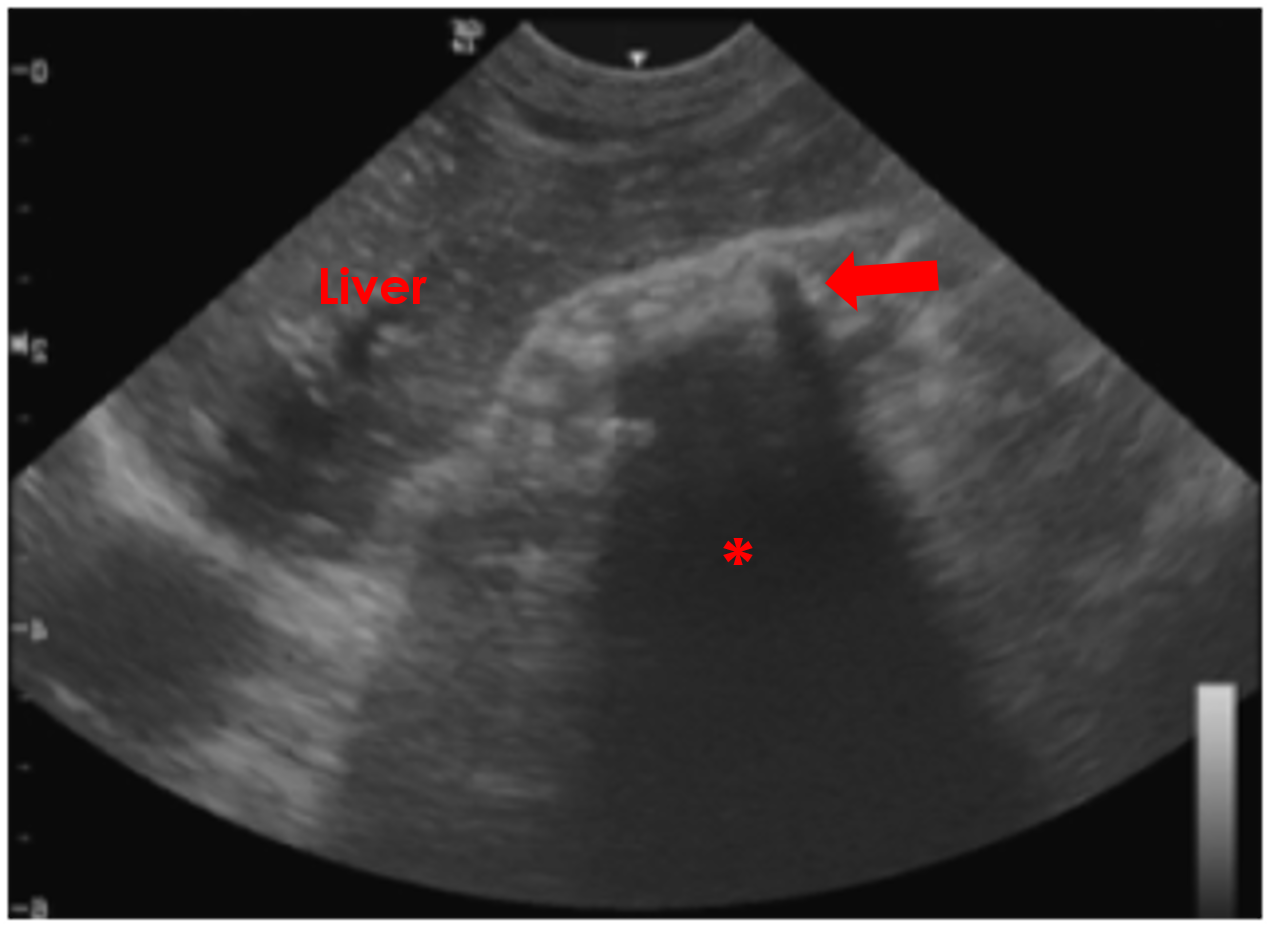 gastric foreign body