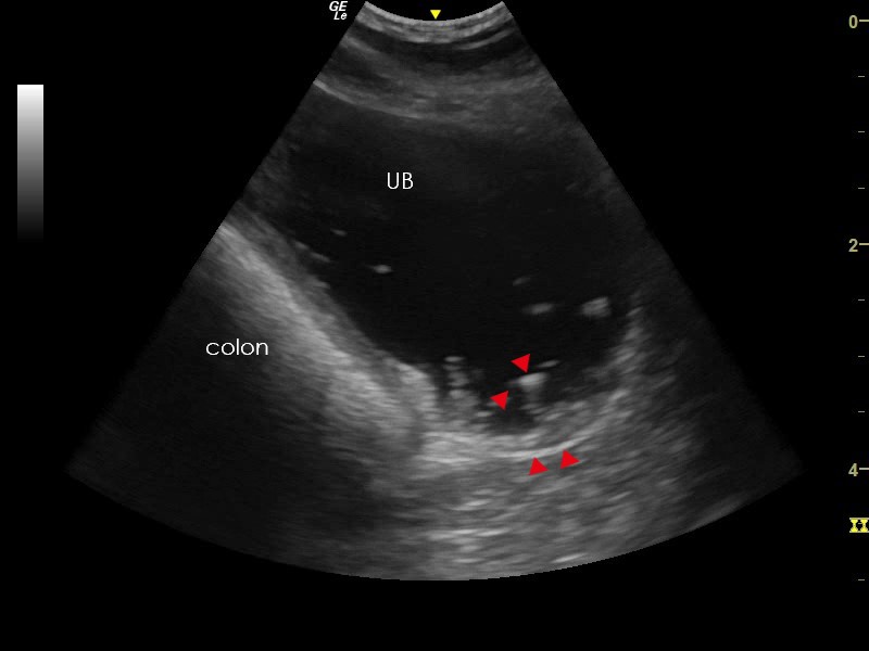 cystitis